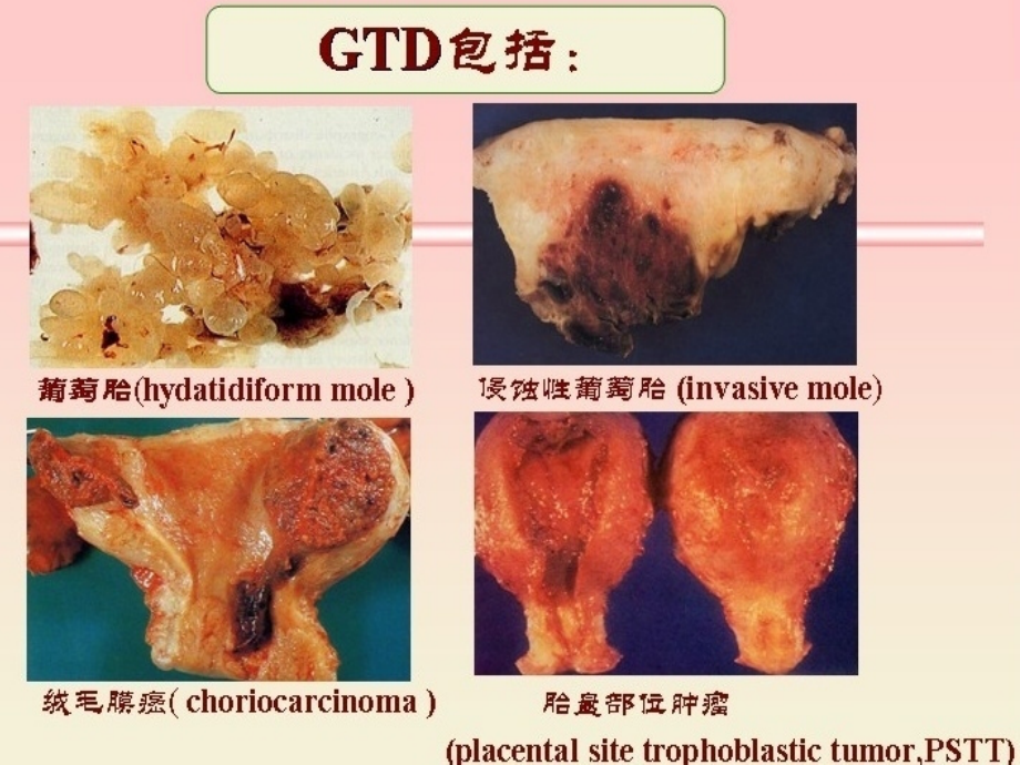 妊娠滋养细胞疾病2015课件_第3页