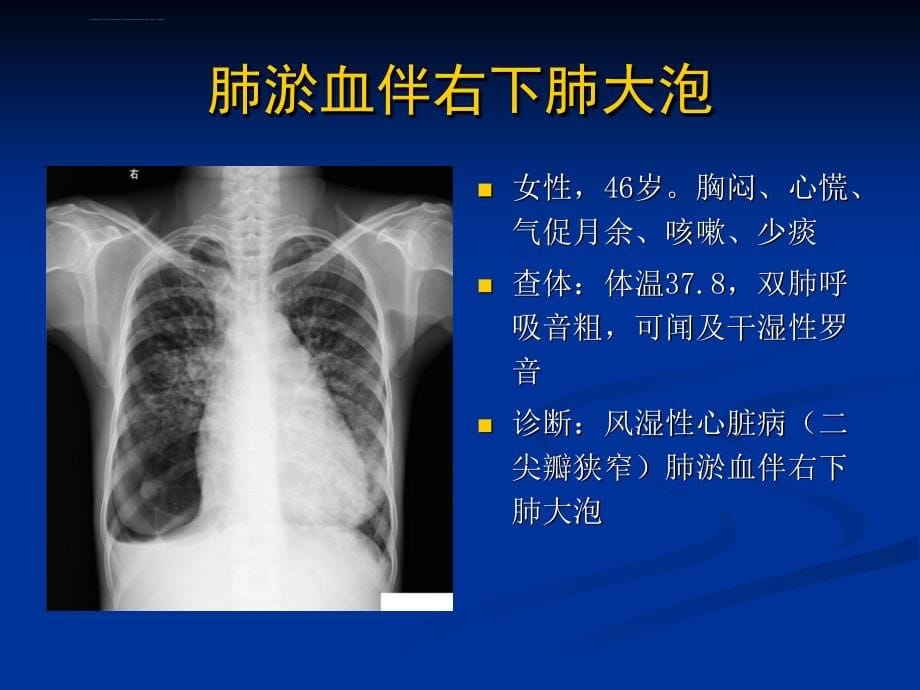 不同类型的肺水肿ct表现及鉴别诊断课件_第5页