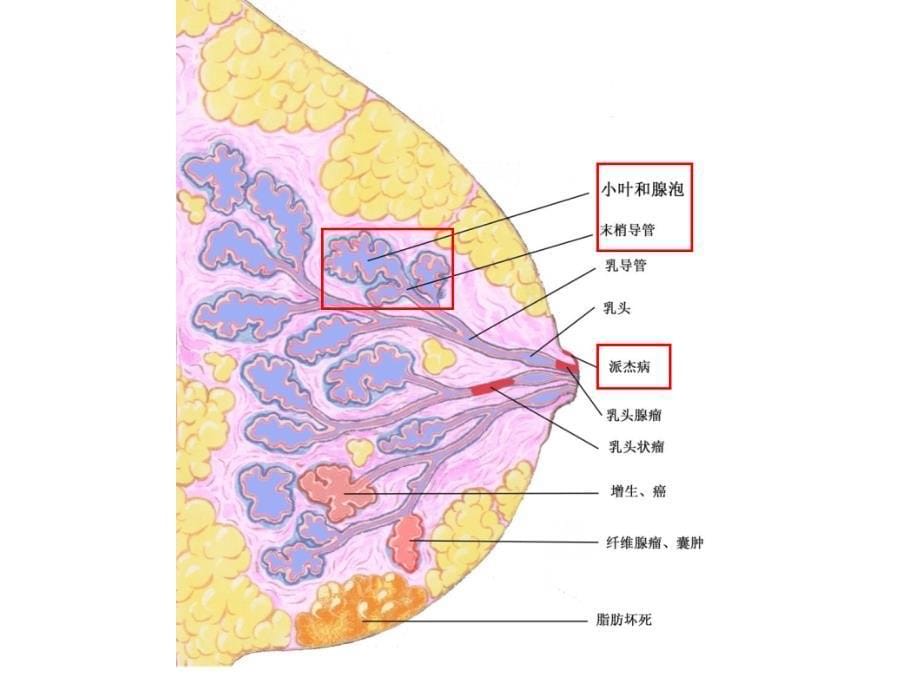 实习14-生殖系统及乳腺疾病课件_第5页