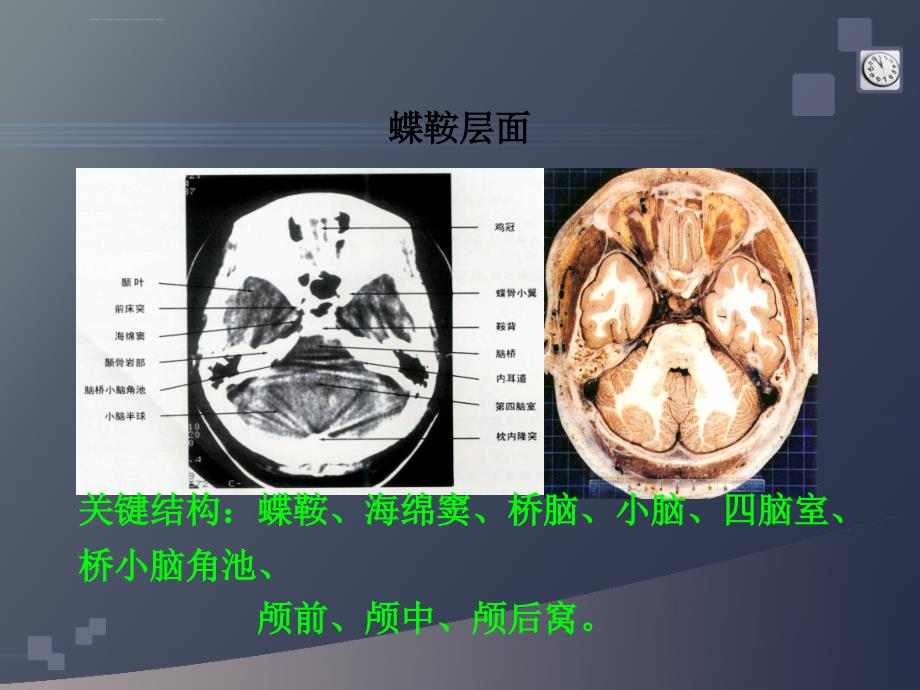 研究生医学影像学-颅脑4-中枢神经系统-星形细胞瘤课件_第3页