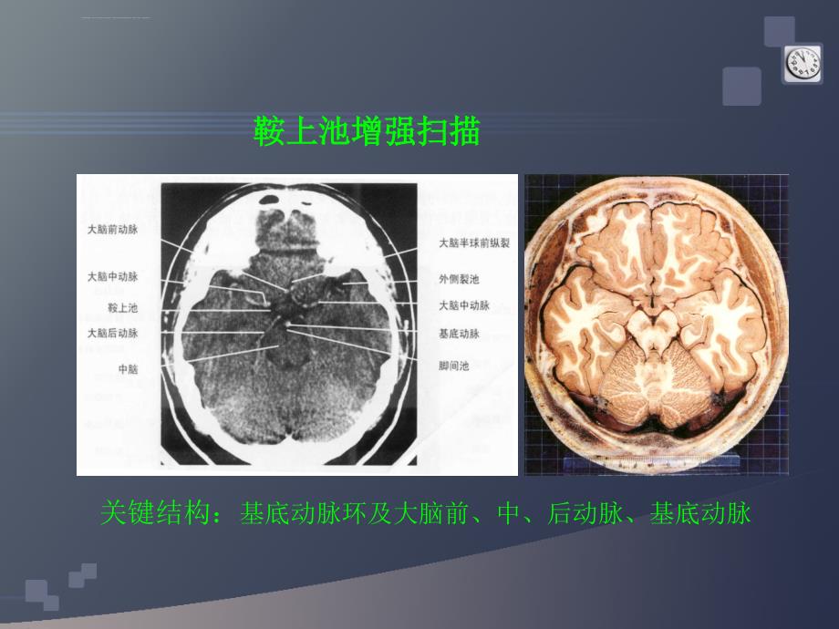 研究生医学影像学-颅脑4-中枢神经系统-星形细胞瘤课件_第4页
