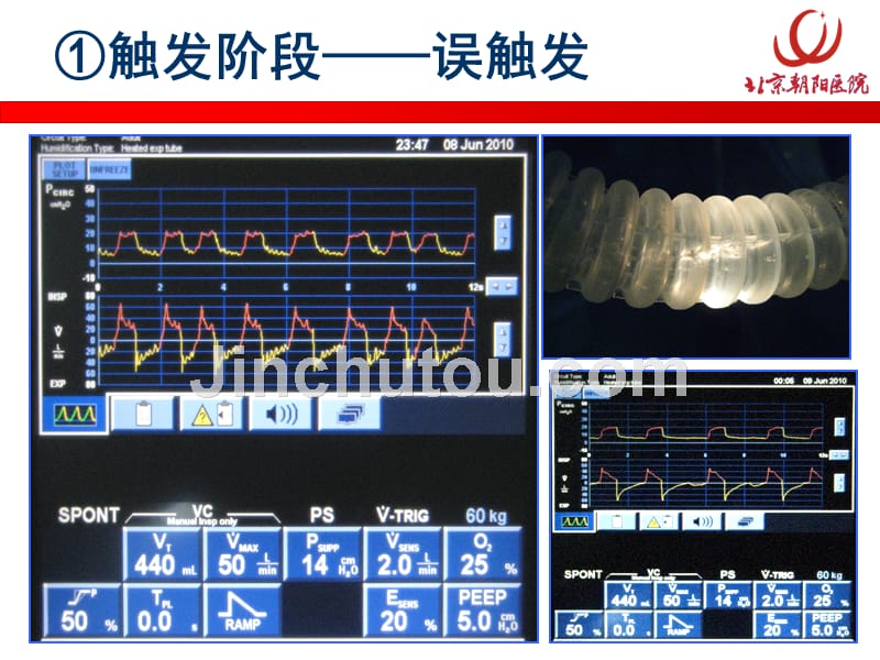 机械通气-人机对抗的原因及处理【高级研修班讲义版】课件_第5页