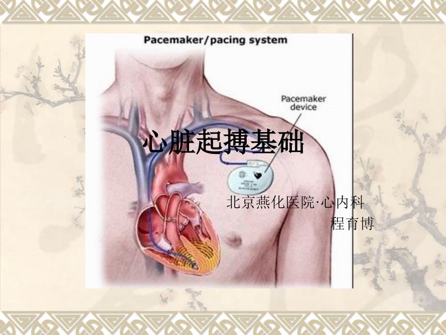 心脏起搏基础课件_第1页