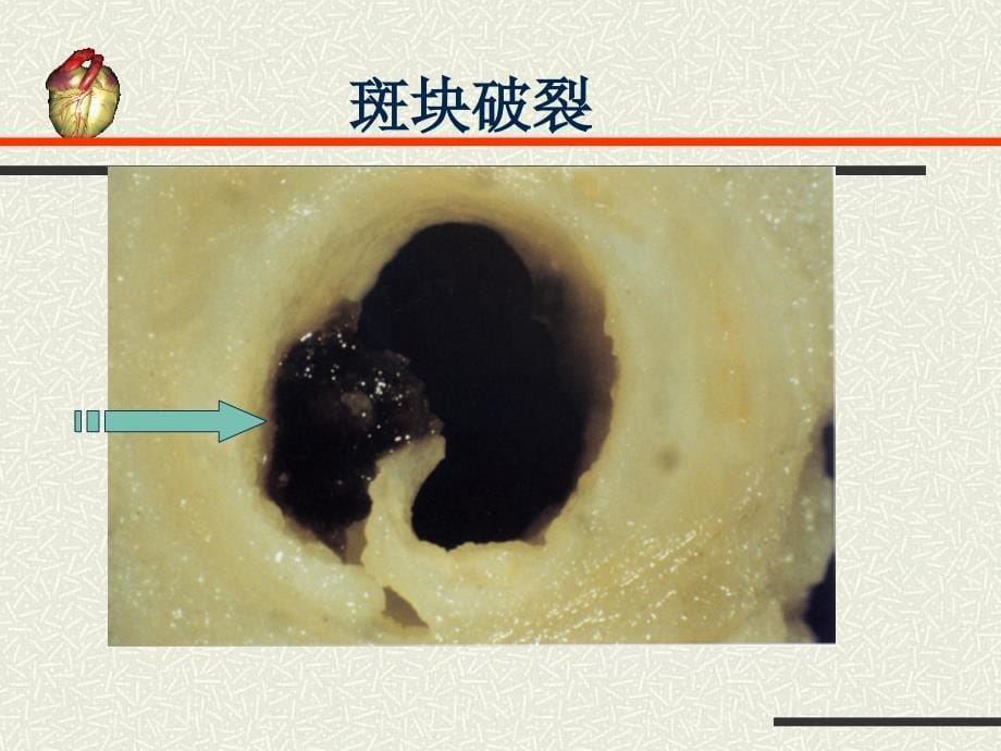 2012急性心肌梗死指南-2课件_第5页