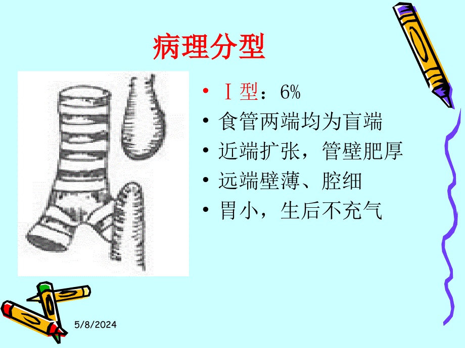 先天性食管闭锁围手术期护理[1]课件_第4页