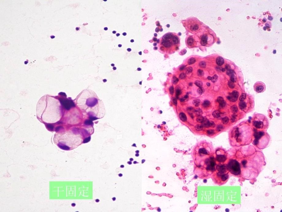 胸腹水脱落细胞学课件_第5页