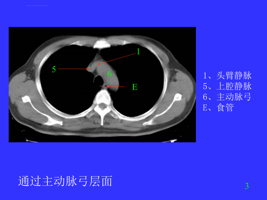 胸部ct诊断我的ppt课件_第4页