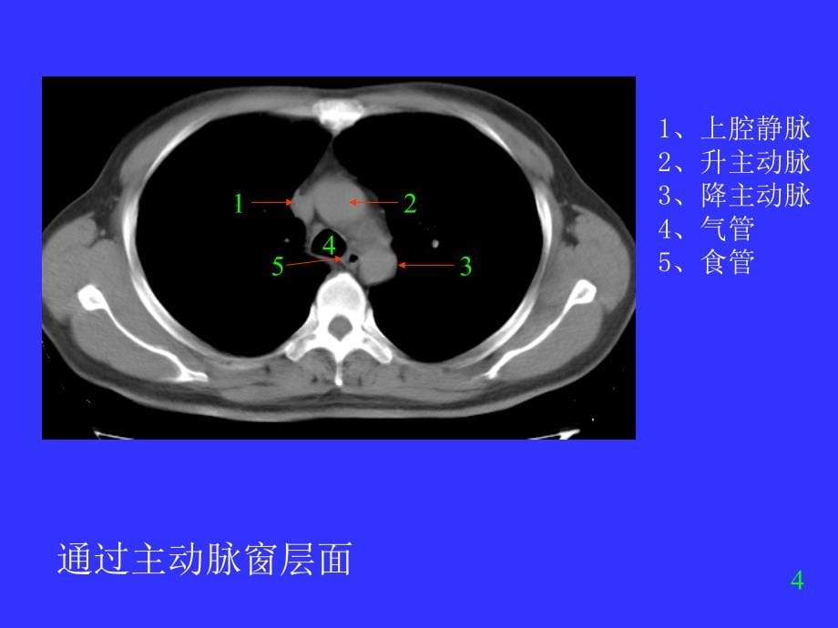 胸部ct诊断我的ppt课件_第5页