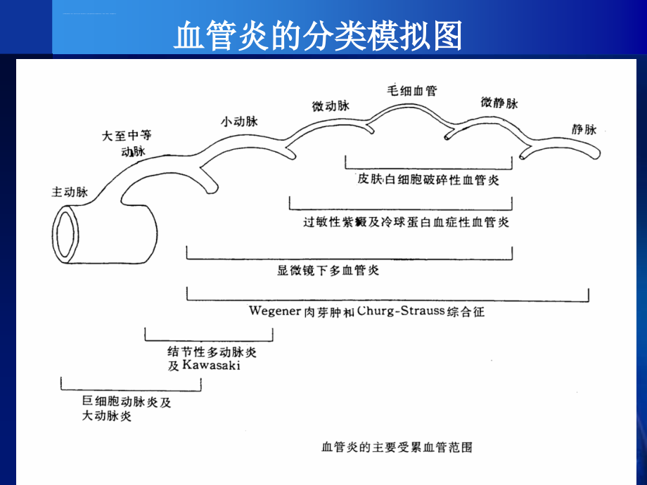 系统性血管炎2010(谢长好)课件_第4页