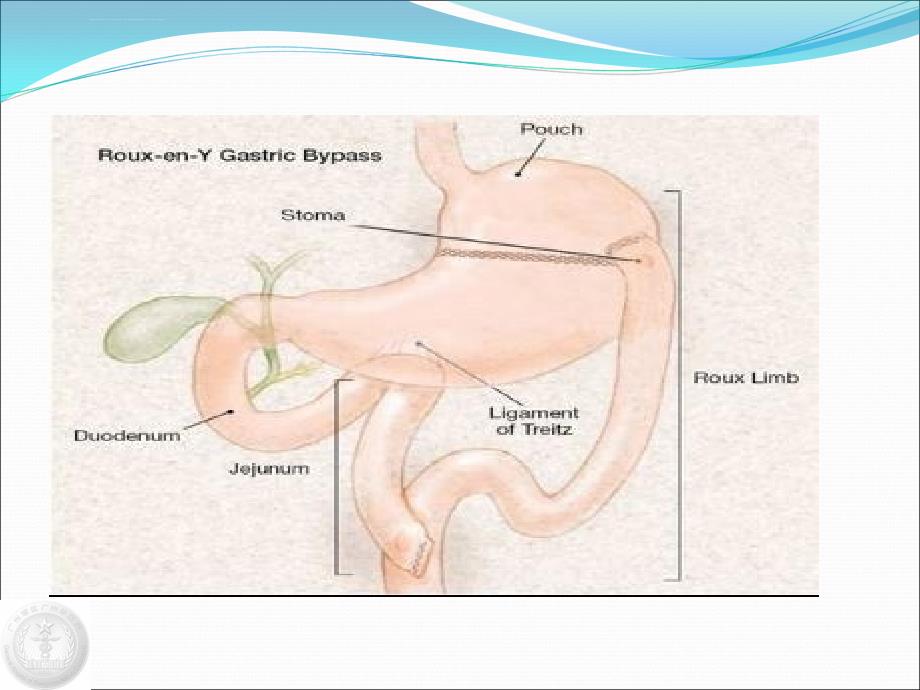 腹腔镜下胃旁路转流术课件_第4页