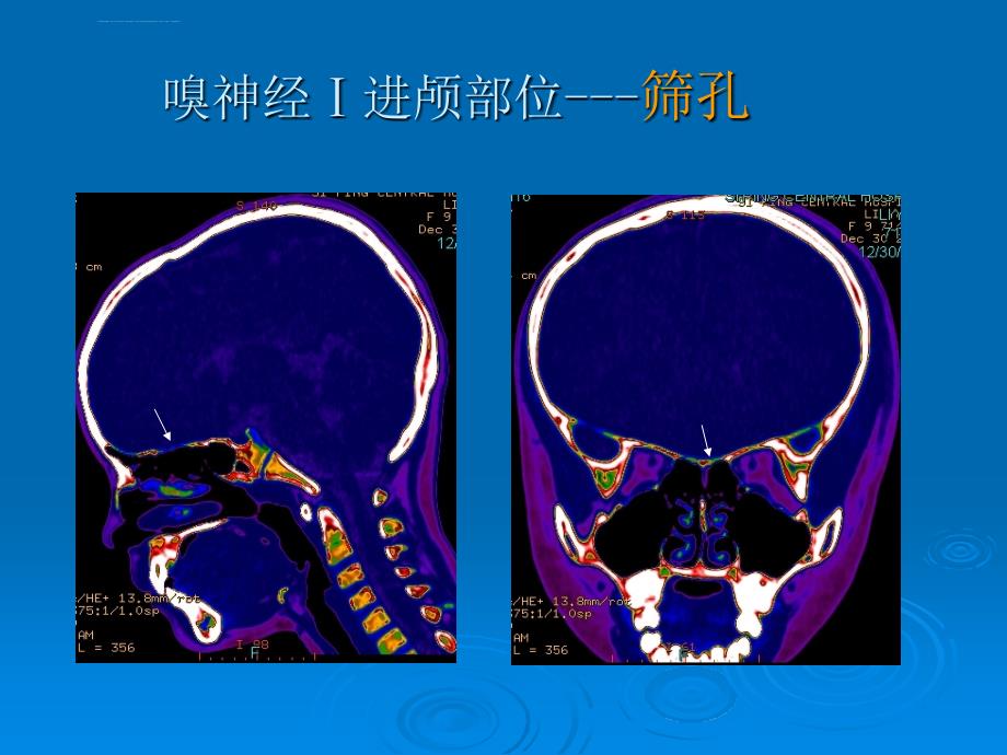 层螺旋ct在颅底解剖课件_第3页