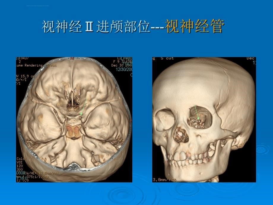 层螺旋ct在颅底解剖课件_第5页