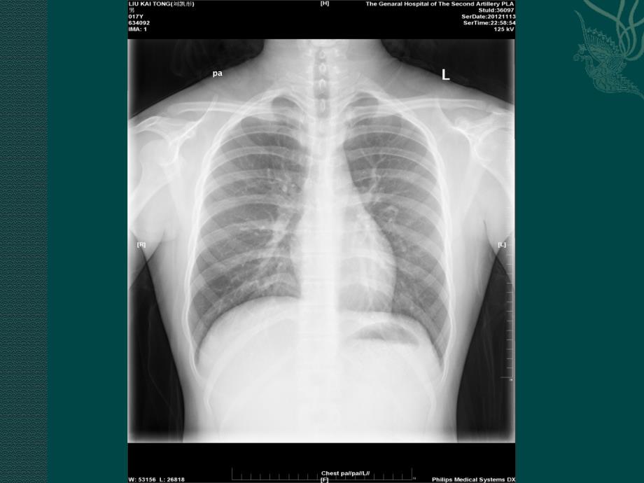 胸部x线常见的疾病课件_第2页