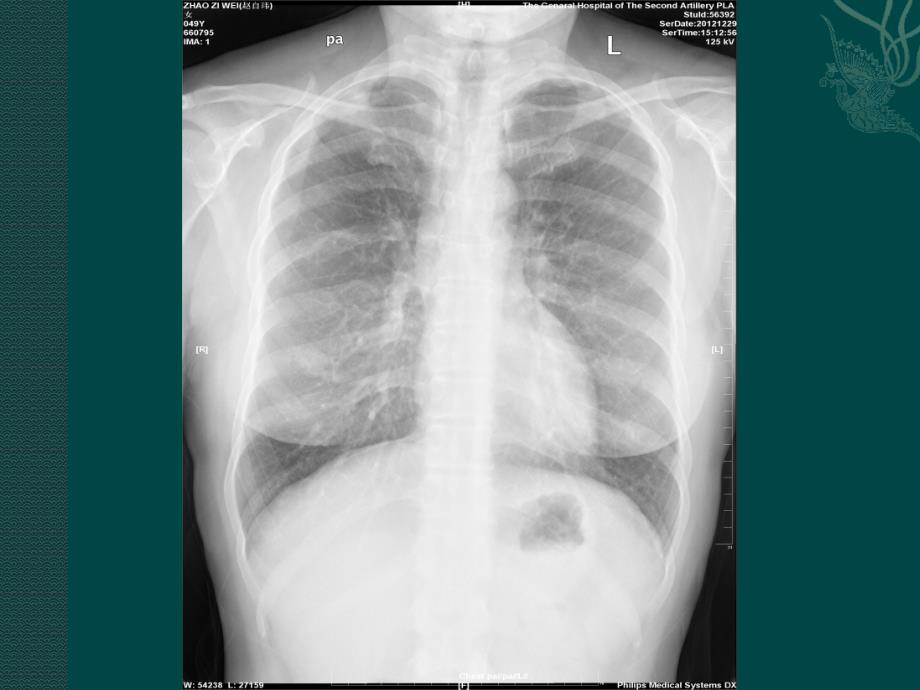 胸部x线常见的疾病课件_第4页