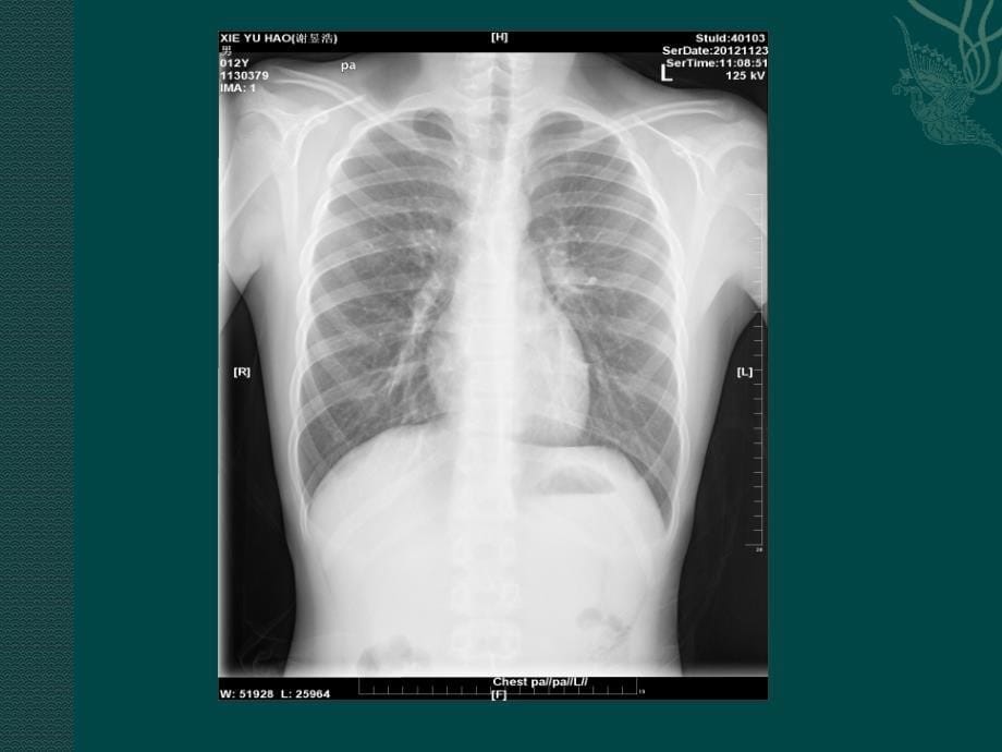 胸部x线常见的疾病课件_第5页