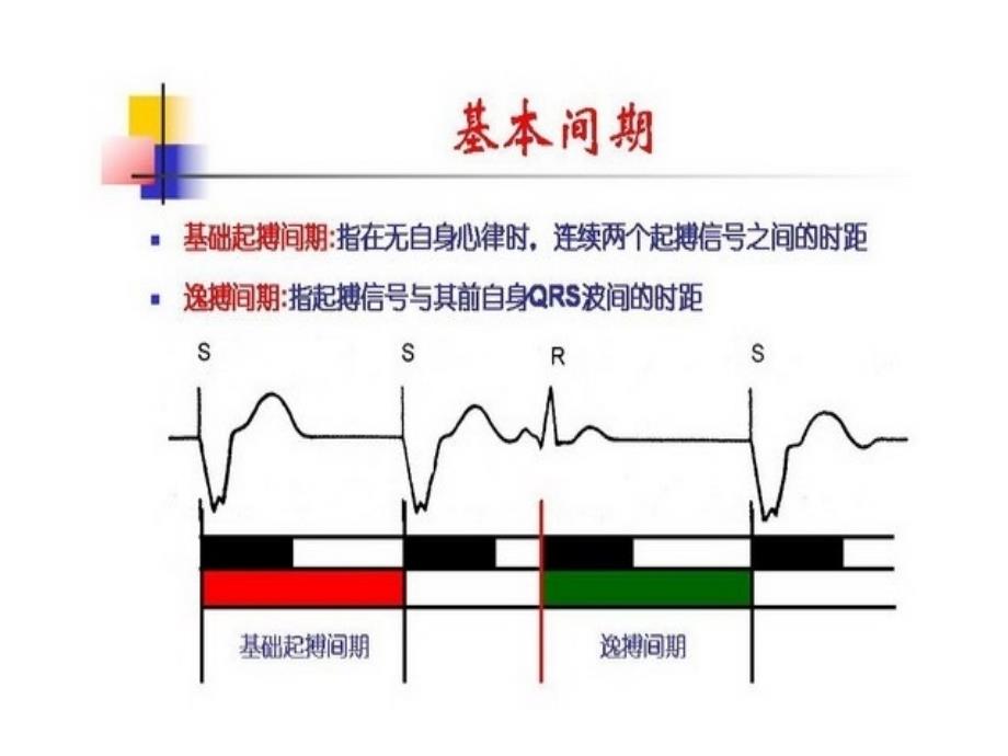 起搏器心电图分析课件_第3页