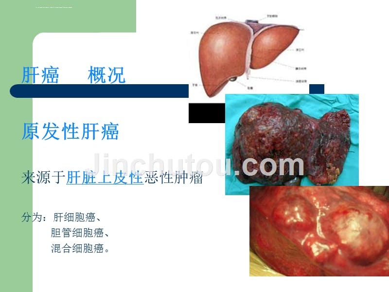 肿瘤介入治疗护理课件_第2页