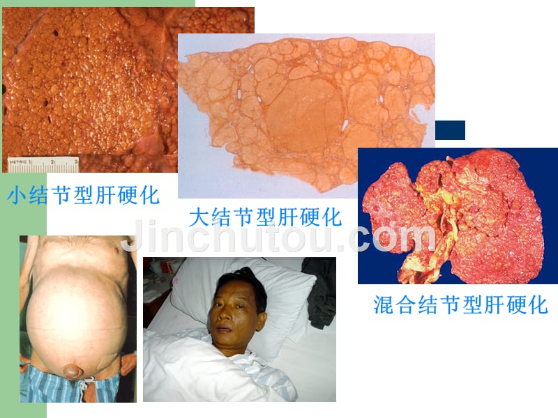 肿瘤介入治疗护理课件_第4页