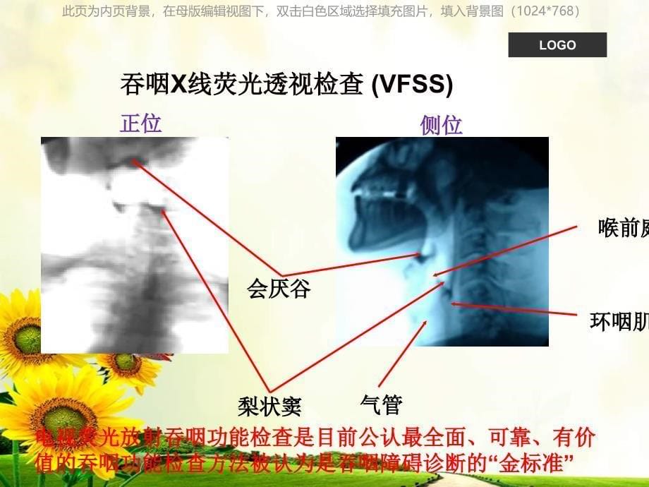 吞咽困难护理查房课件_第5页