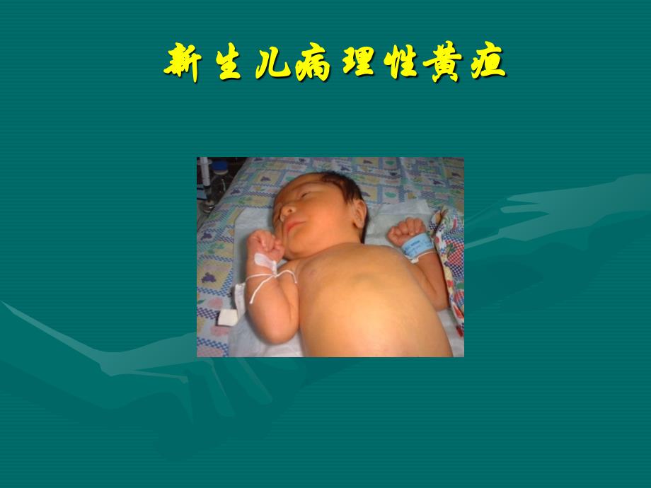 新生儿病理性黄疸课件_第1页