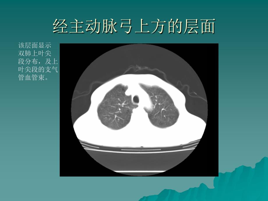 胸部的-ct-解剖及肺癌的-ct1_第4页