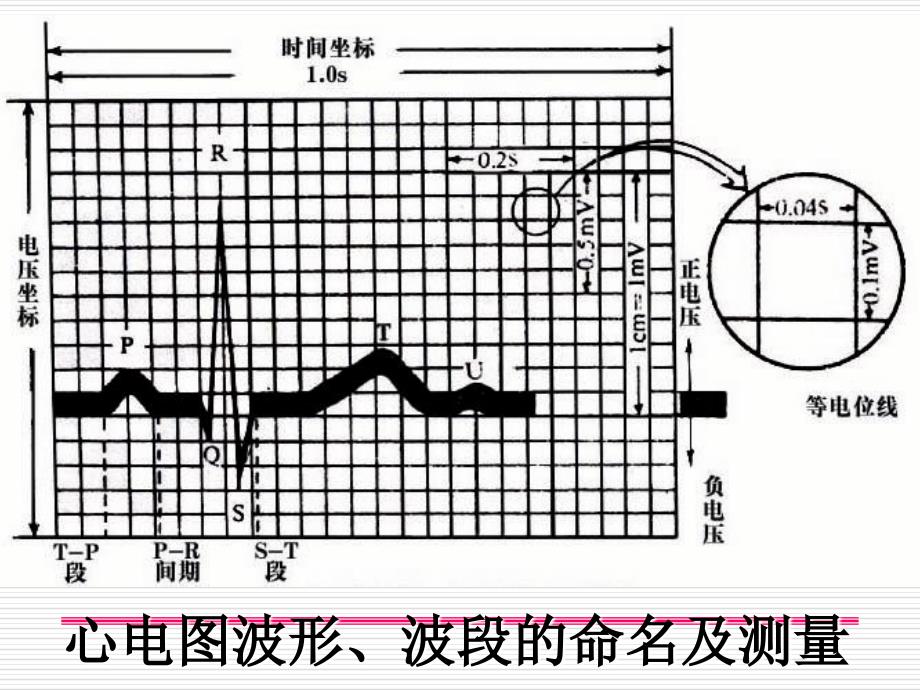 异常心电图汇总_第3页