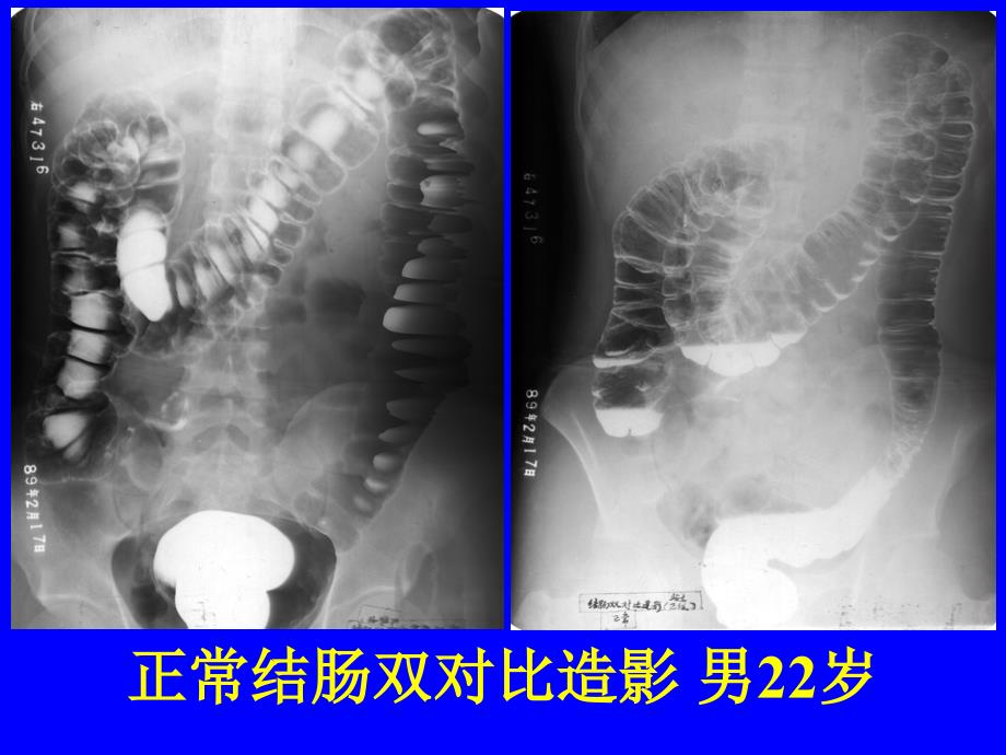 消化系统疾病典型片课件_第3页