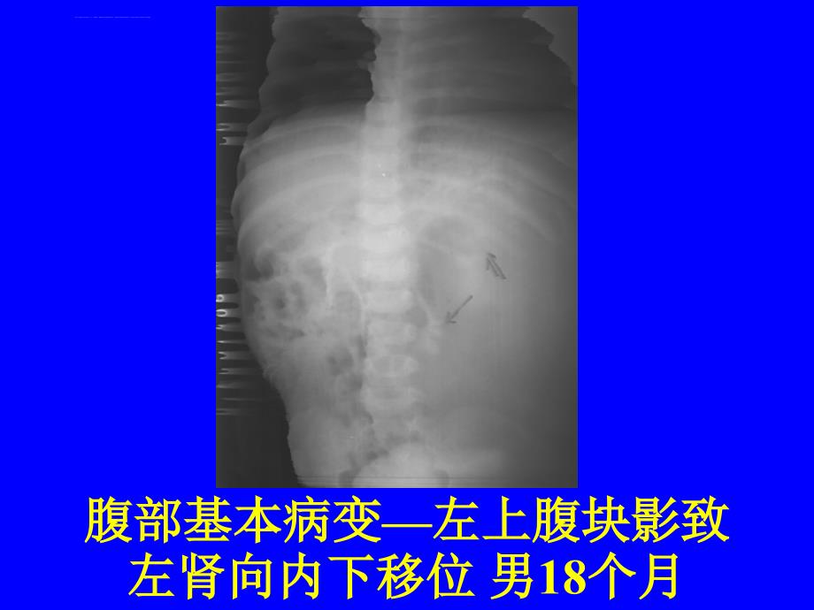 消化系统疾病典型片课件_第4页