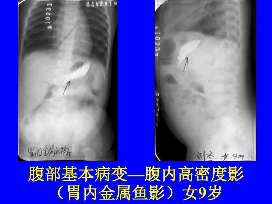 消化系统疾病典型片课件_第5页