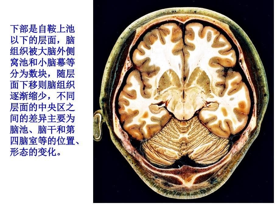 头部（颅脑连续横断层解剖）断层课件_第5页