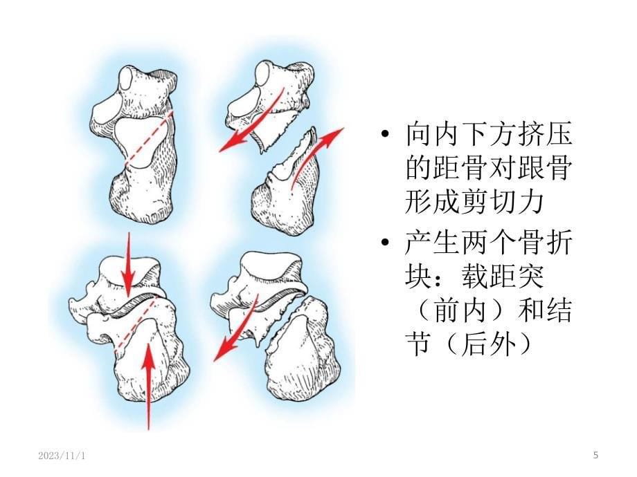 跟骨骨折小讲课_第5页