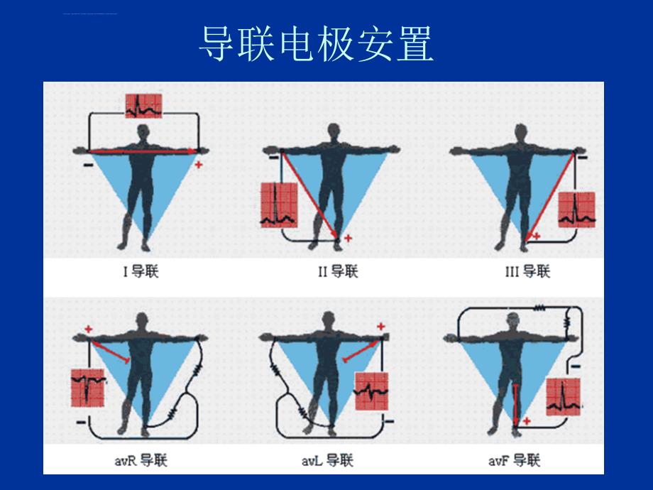 临床心电图解析-福建医大教学课件_第4页