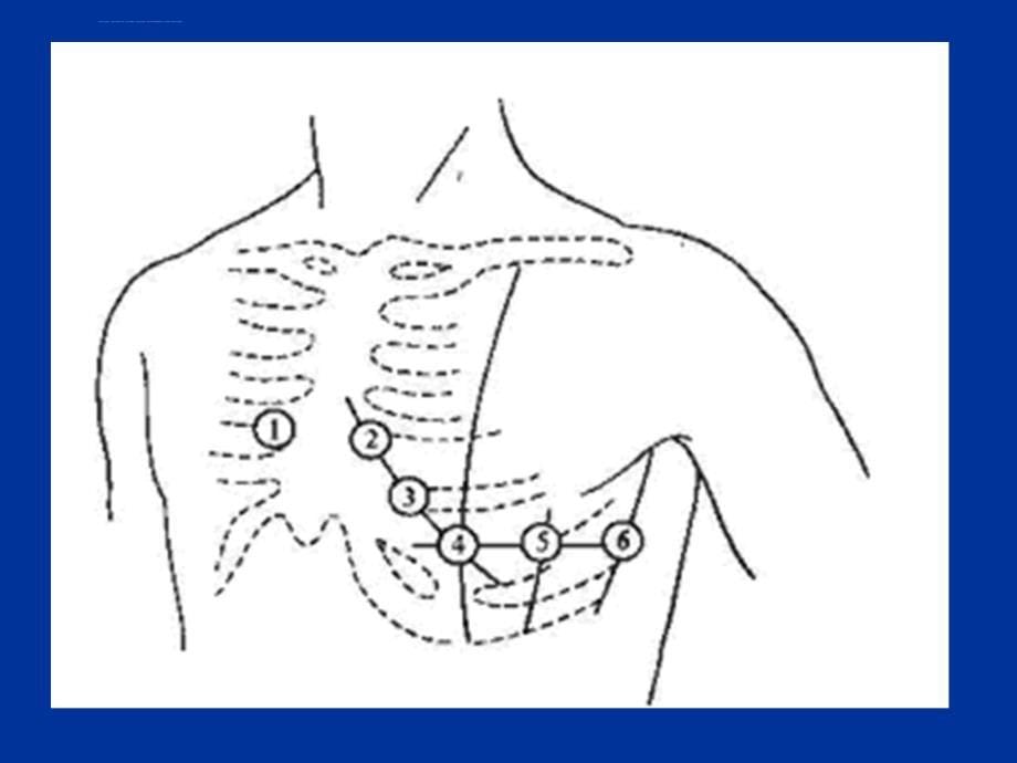 临床心电图解析-福建医大教学课件_第5页