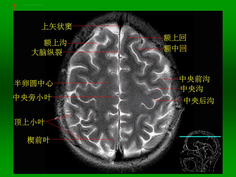 颅脑mri断层解剖与影像_第2页