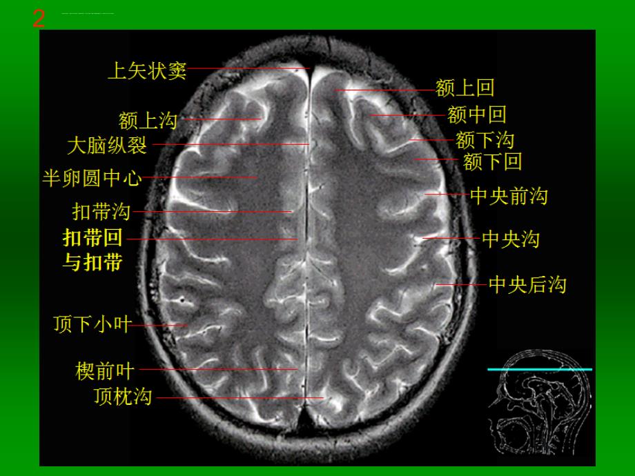 颅脑mri断层解剖与影像_第4页