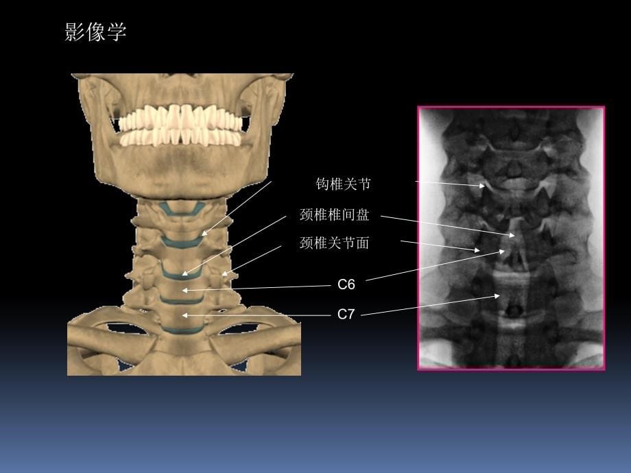 颈椎病和腰椎间盘突出症的诊治课件_第5页