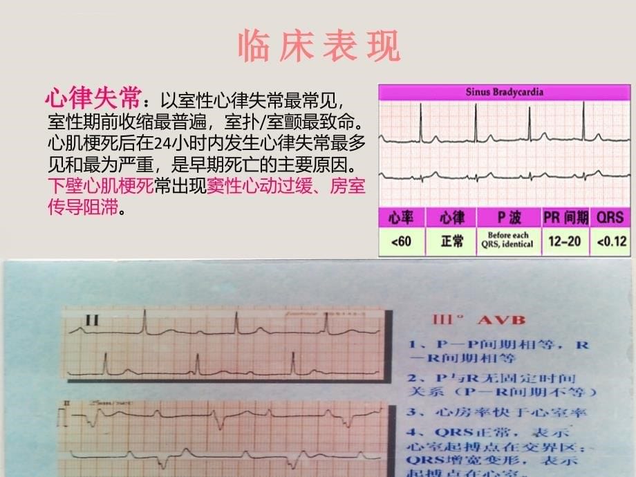 急性心肌梗死护理查房--朱钦兰心得课件_第5页