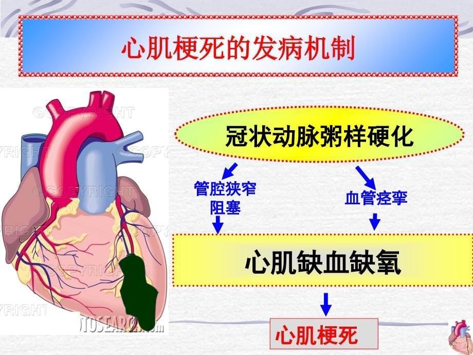 急性心肌梗死的护理1课件_第5页