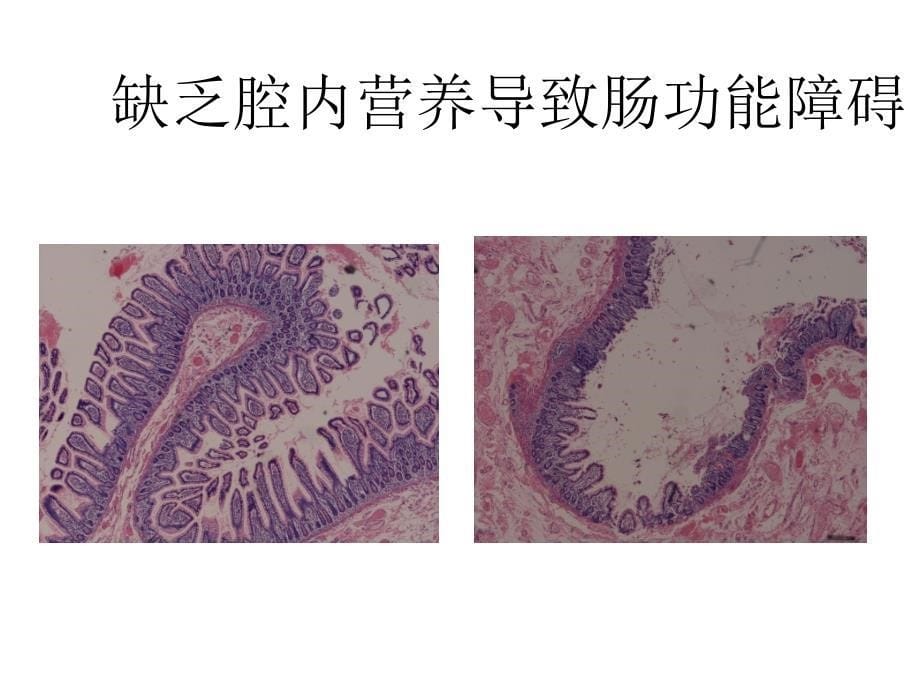 实施肠内营养的重要性与对策课件_第5页