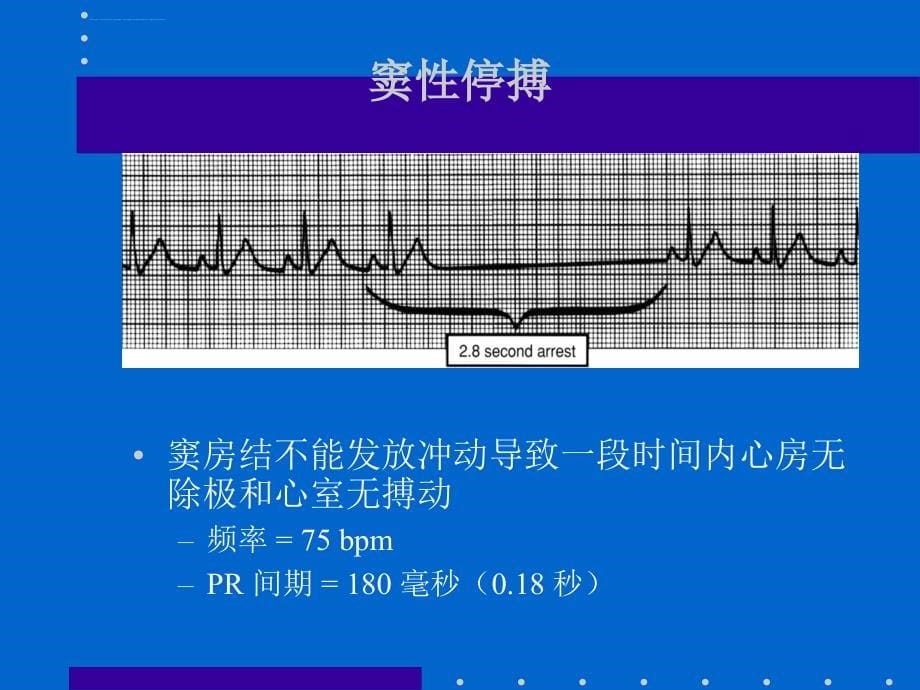 心律失常各论_第5页