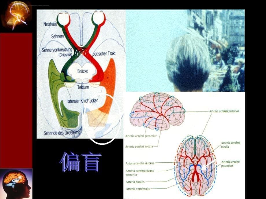 缺血性脑血管病阿司匹林应用中国专家共识课件_第5页
