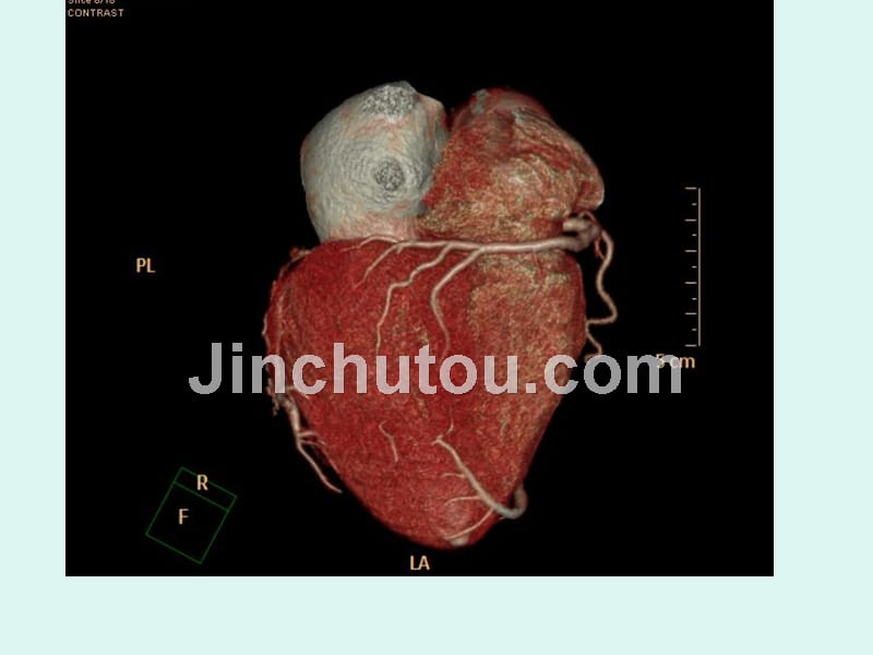心脏冠状动脉cta成像课件_第5页