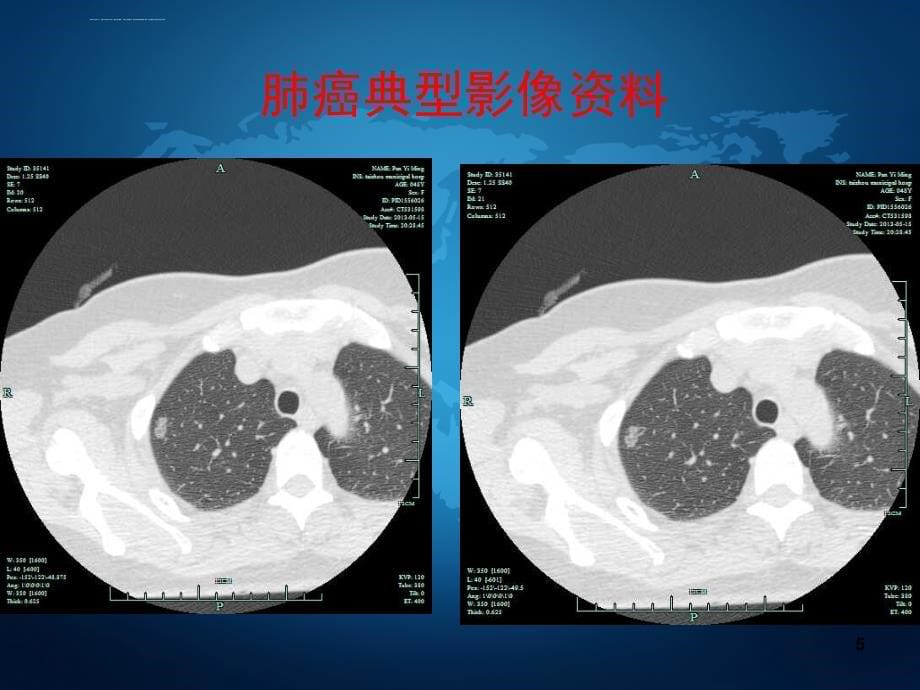 肺癌诊断治疗课件_第5页