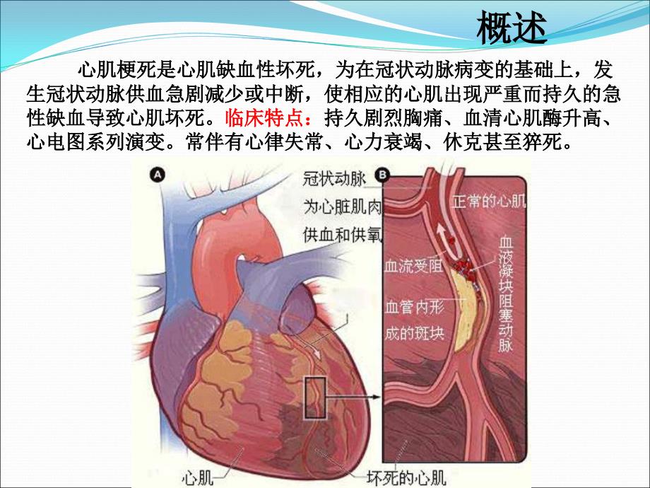 面试ppt-内科急性心肌梗死_第3页