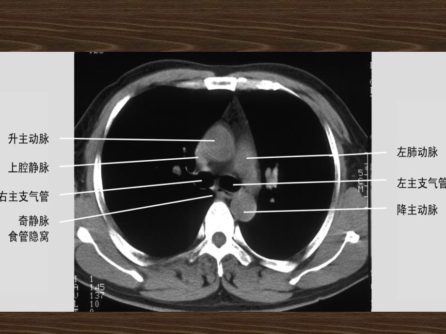 胸部病变ct诊断_第5页