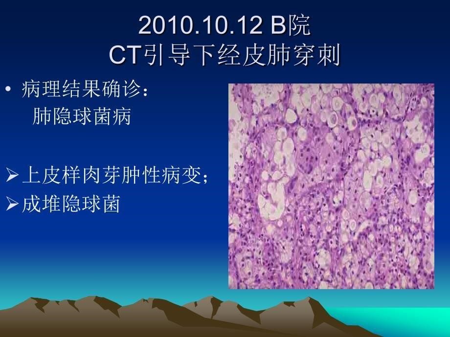 肺隐球菌病_第5页