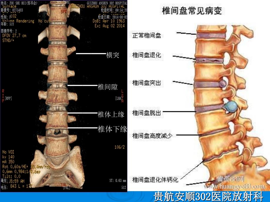 腰椎x检查摄影技术-2_第4页