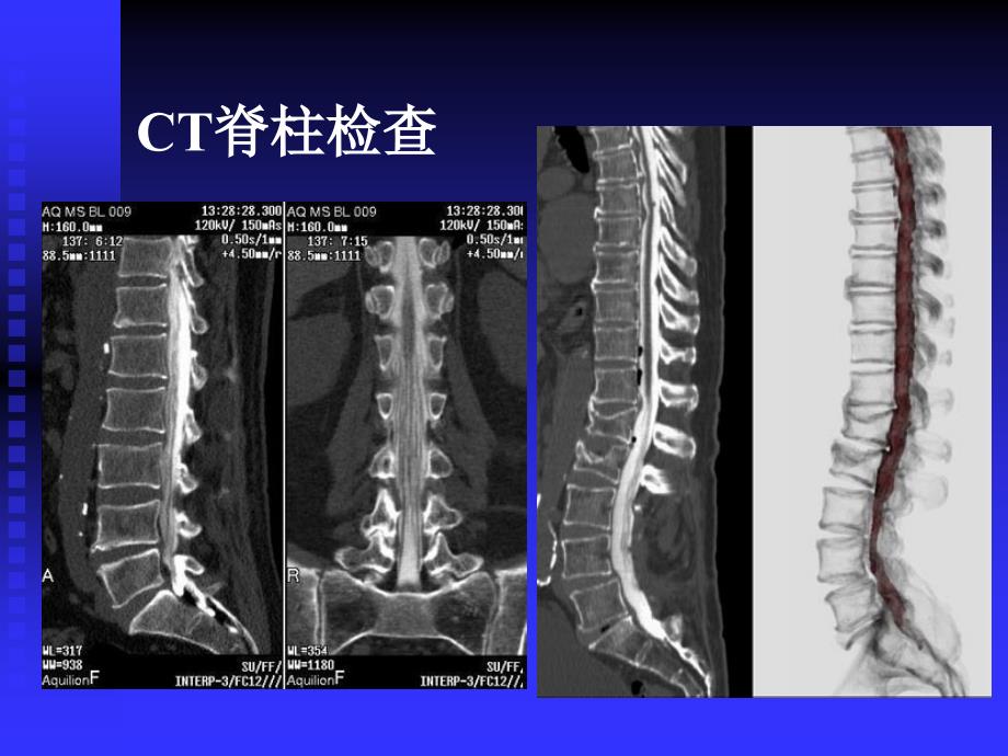 《柱肿瘤》ppt课件_第3页