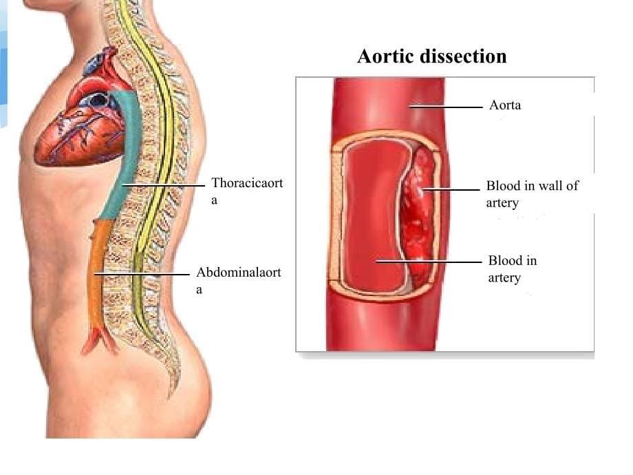 主动脉夹层的临床表现和护理措施_第5页