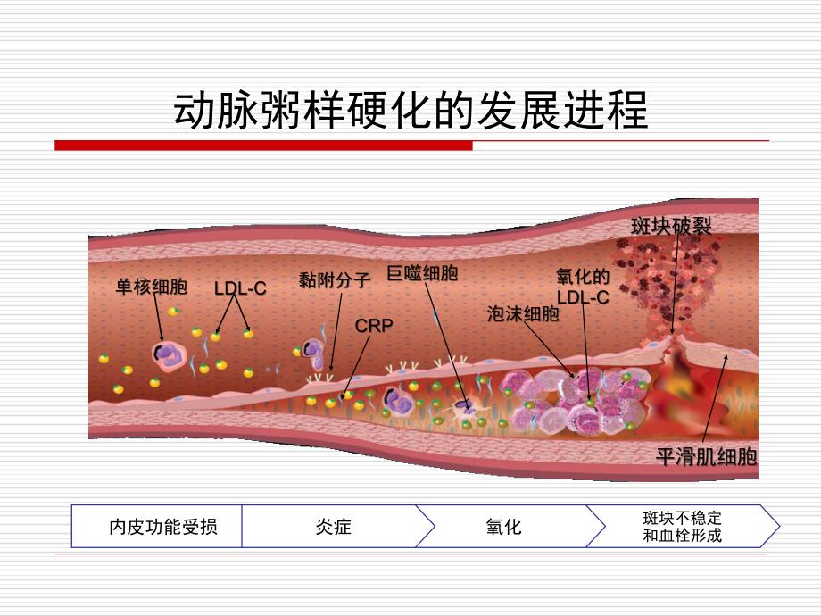 方唯一-急性冠脉综合征介入治疗进展及争议_第2页